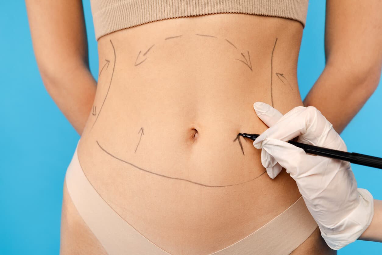 Close up da mão de um médico fazendo linhas pontilhadas na barriga de paciente.