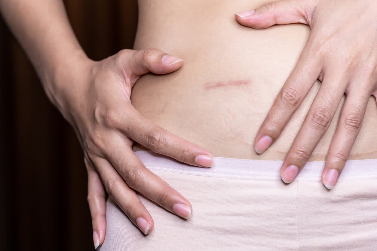 Close de uma cicatriz com queloide na região da barriga de uma mulher