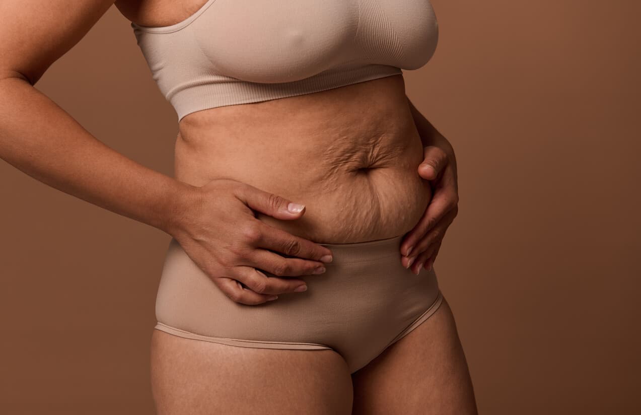 Mulher com flacidez abdominal segurando a região da barriga