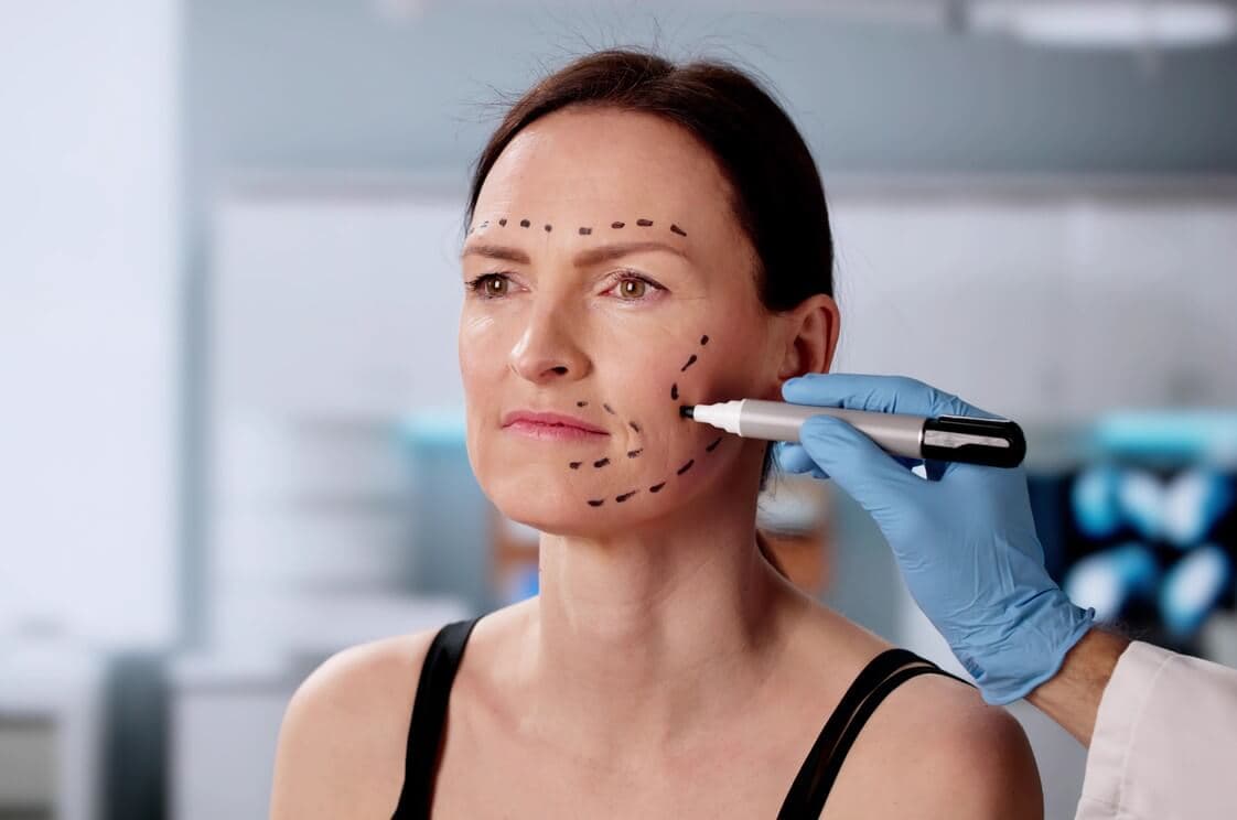 Mulher em consulta estética com marcações cirúrgicas no rosto, enquanto um profissional de saúde com luvas azuis desenha linhas de planejamento facial na região da bochecha e mandíbula.