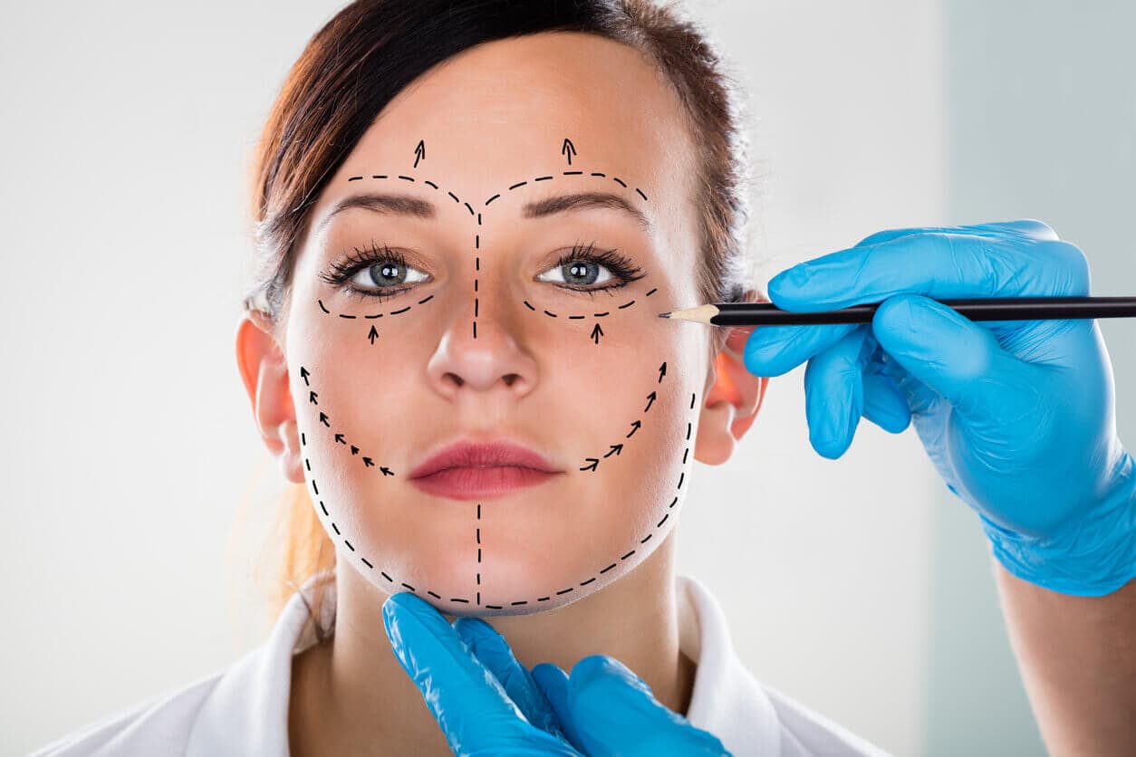 Mulher com marcações cirúrgicas no rosto durante avaliação pré-operatória de microlifting, enquanto profissional com luvas aponta áreas de correção facial.