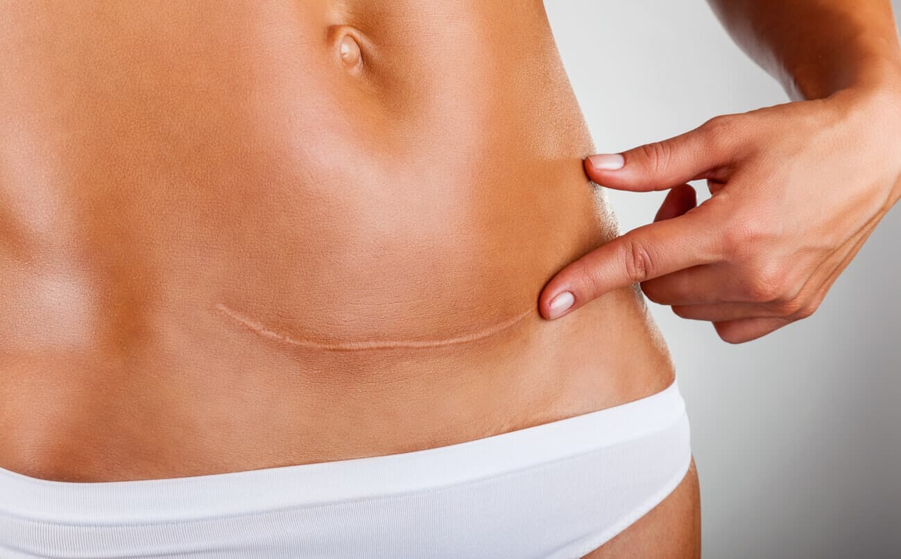 Cicatriz abdominal baixa em fase de cicatrização no pós-abdominoplastia, destacando cuidados e evolução da recuperação cirúrgica.