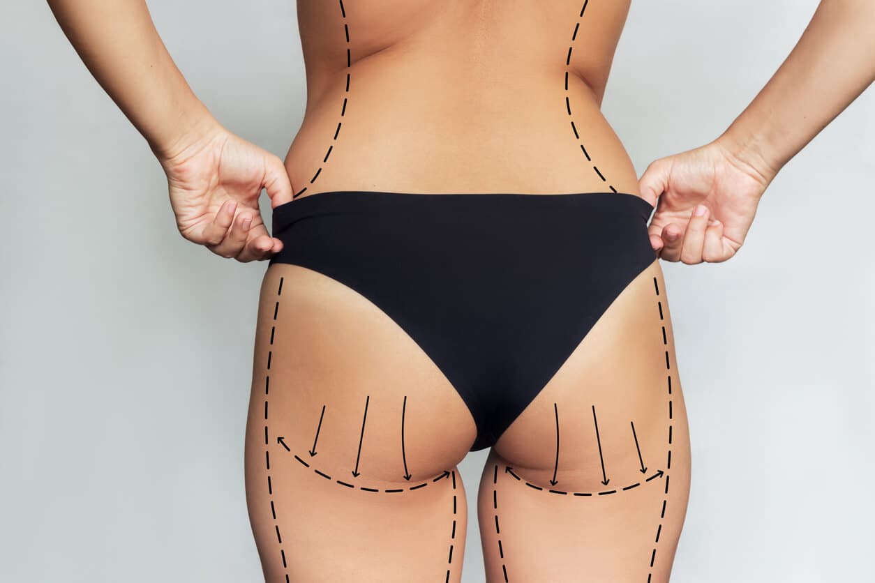 Vista traseira de uma mulher ajustando a calcinha preta enquanto marcações cirúrgicas indicam áreas de lipoescultura e contorno corporal nos glúteos, coxas e cintura.