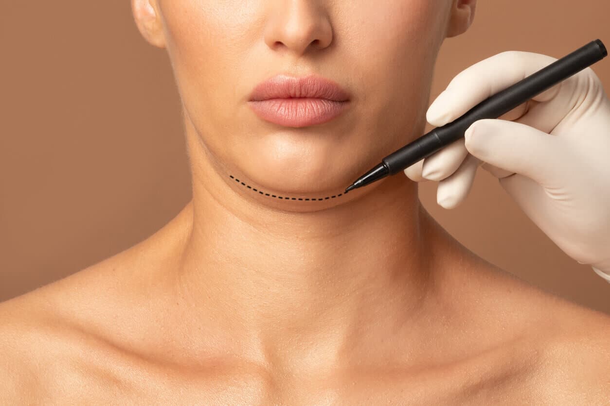 Close do terço inferior do rosto e pescoço de uma mulher, enquanto uma mão com luva marca a região abaixo do queixo com caneta, indicando planejamento para lipo de papada.