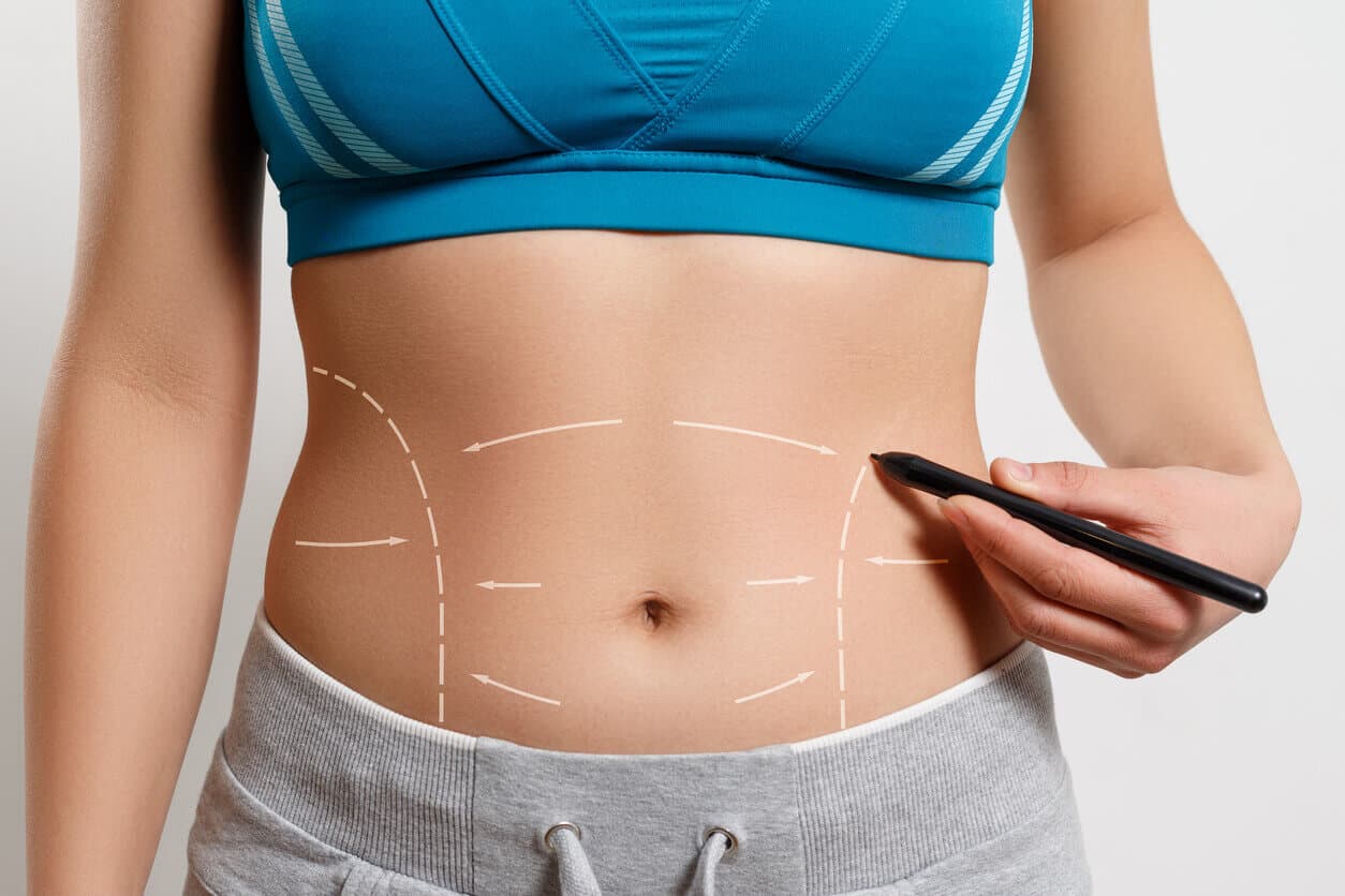 Pessoa com roupa esportiva mostrando o abdômen marcado com linhas e setas, representando o planejamento e os cuidados após uma cirurgia abdominal.