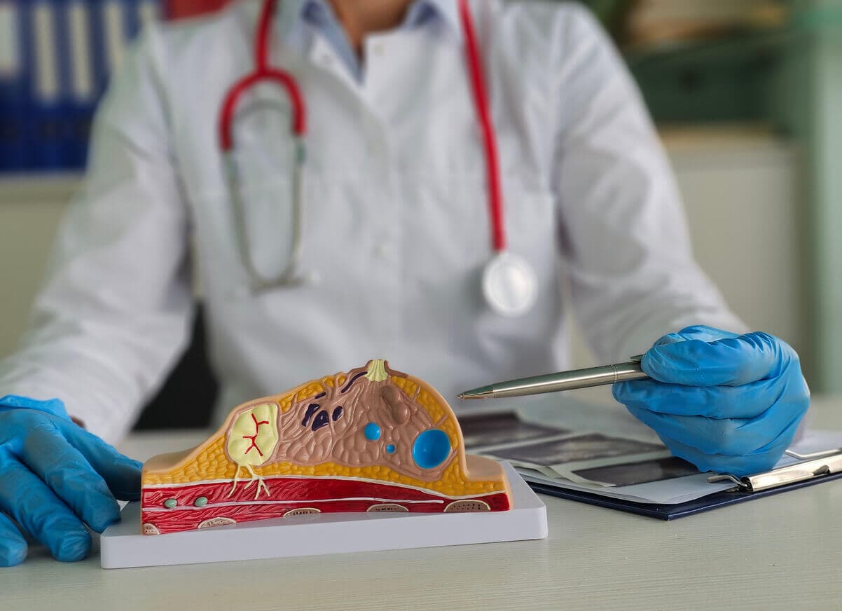 Médico explicando, com modelo anatômico, como ocorre a ginecomastia e quais tecidos são afetados pela condição.