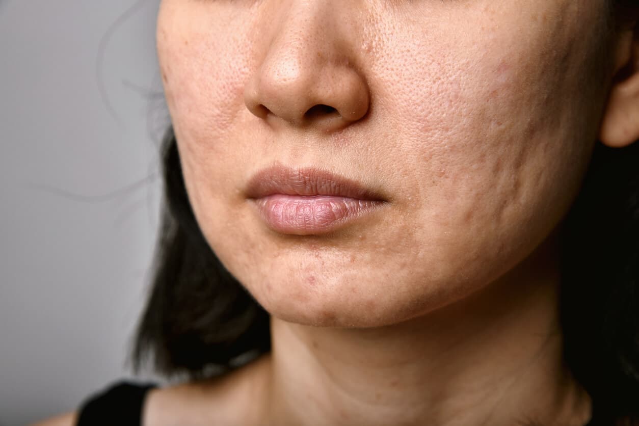 Terço inferior do rosto de uma mulher com cicatrizes de acne.