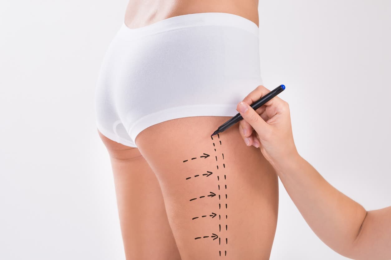 Profissional marca a lateral da coxa de uma paciente com caneta cirúrgica, indicando áreas para procedimento estético de lifting de coxas.