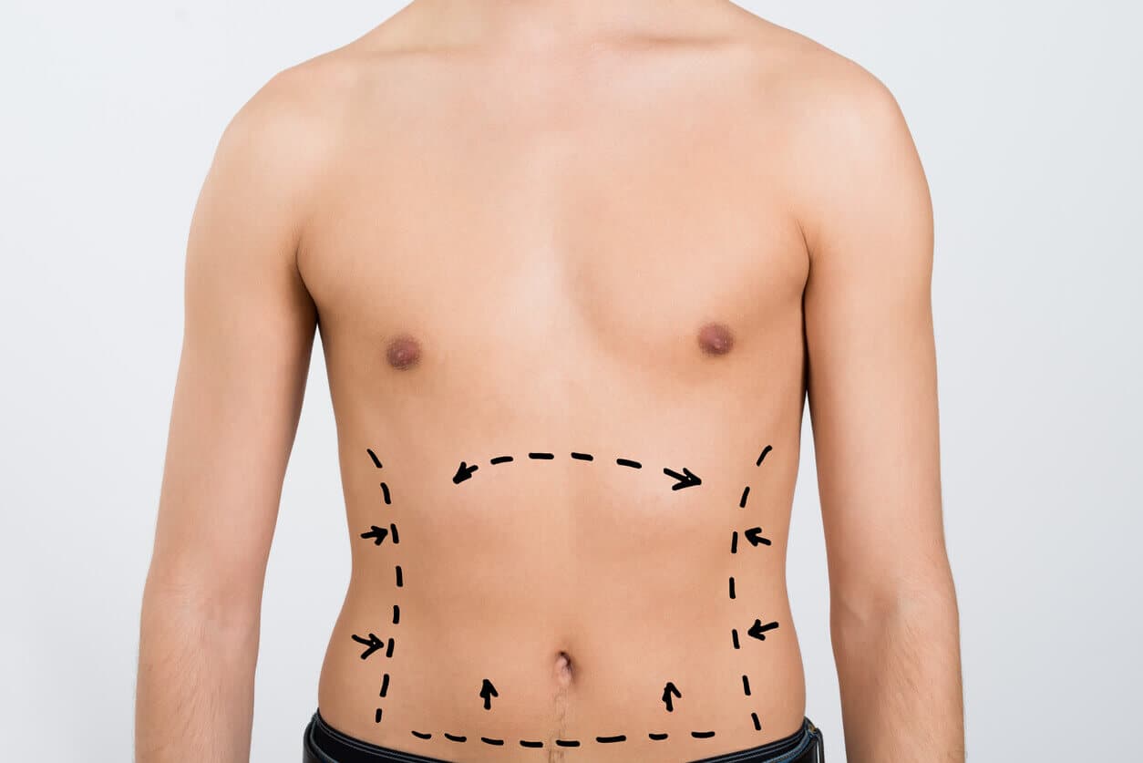 Paciente do sexo masculino com marcações no abdômen em preparação para realizar uma lipo HD masculina