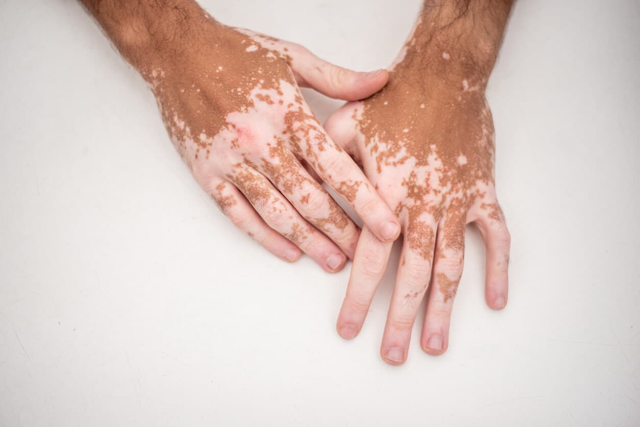 Mãos de uma pessoa com manchas claras características do vitiligo, mostrando a diferença de pigmentação na pele que pode ser tratada com micropigmentação paramédica.