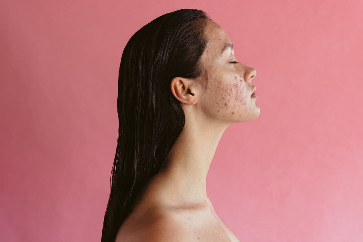 Fundo rosa com um mulher jovem a frente, de perfil, evidenciando o quadro de acne adulta em seu rosto
