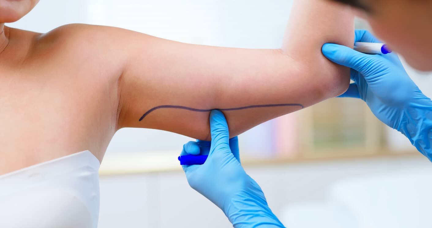 Profissional de saúde com luvas marcando a região posterior do braço de paciente com caneta cirúrgica, indicando área para procedimento estético de remoção de gordura localizada.