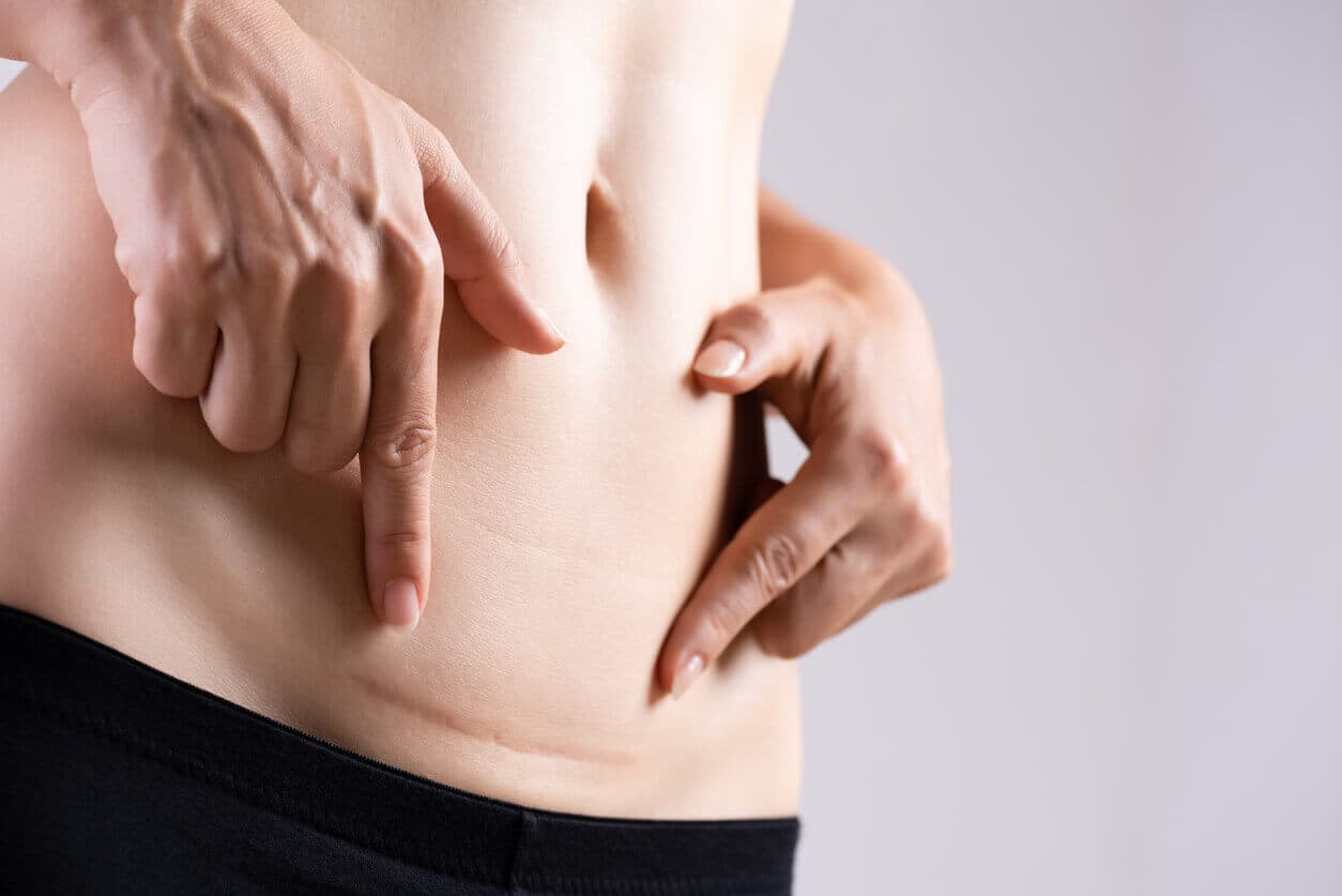Mulher apontando para cicatriz abdominal, sinalizando possível problema na cicatrização pós-cirúrgica