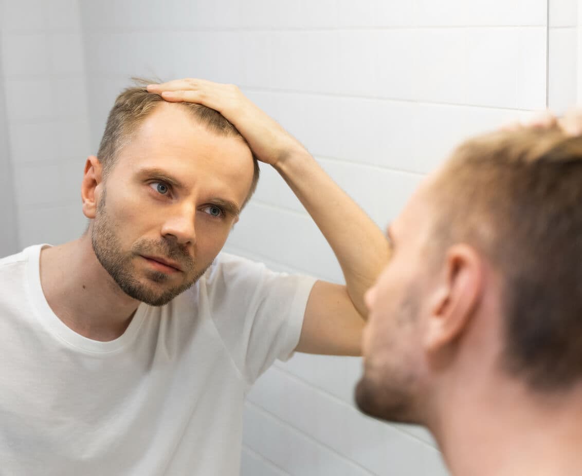 Homem em frente ao espelho, com as mãos segurando o cabelo para trás, evidenciando as falhas de cabelo causadas pela calvície