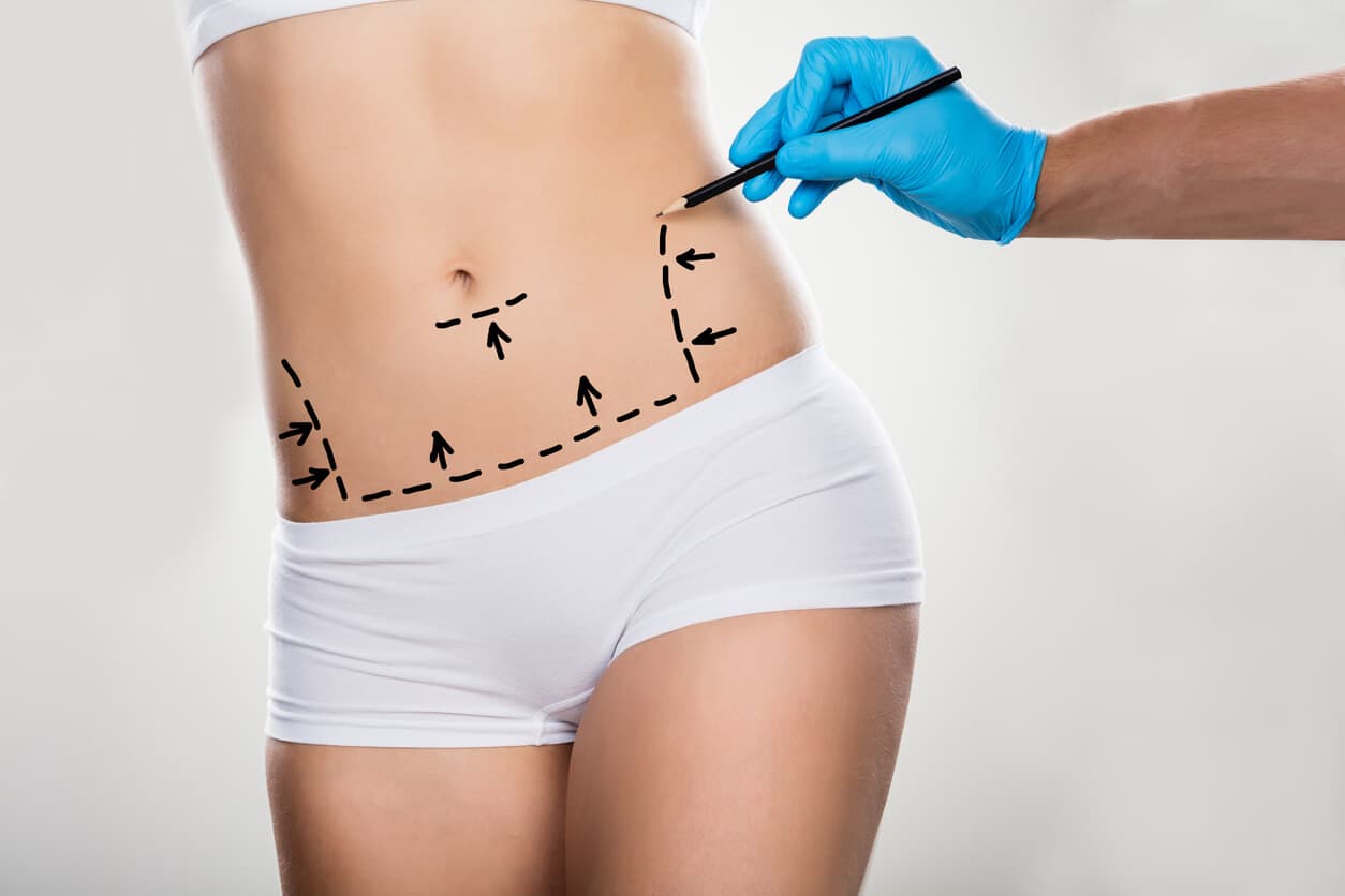 Mãos de um cirurgião fazendo marcações cirúrgicas no abdômen de uma paciente para a abdominoplastia