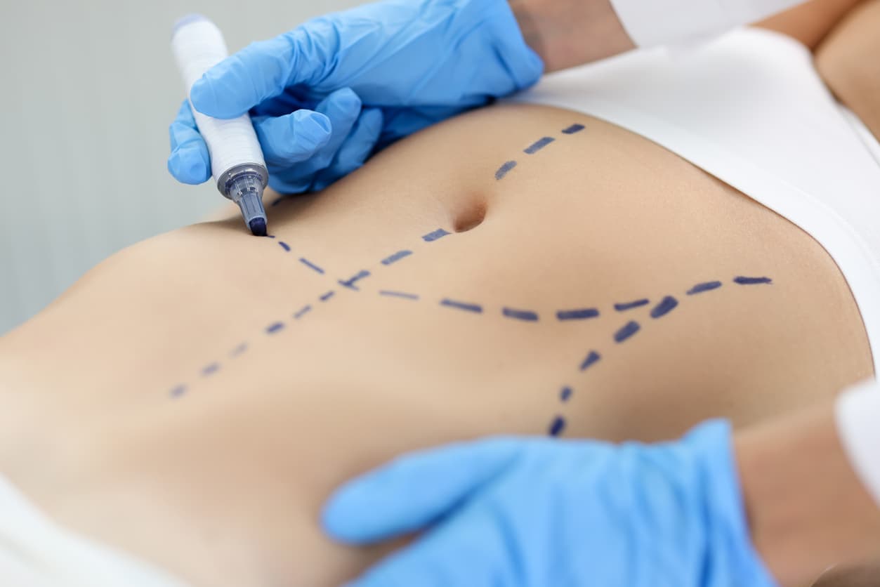 anestesia na abdominoplastia