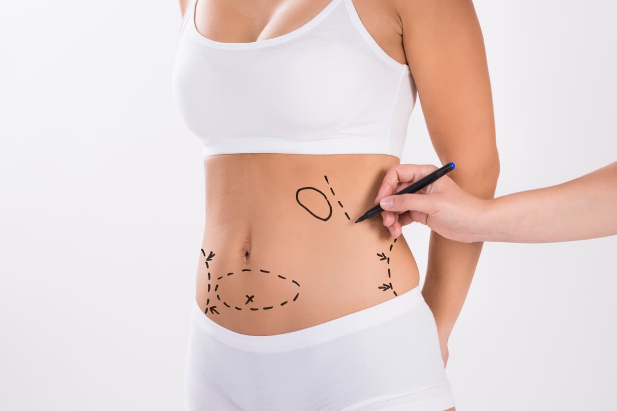 cicatriz em abdominoplastia