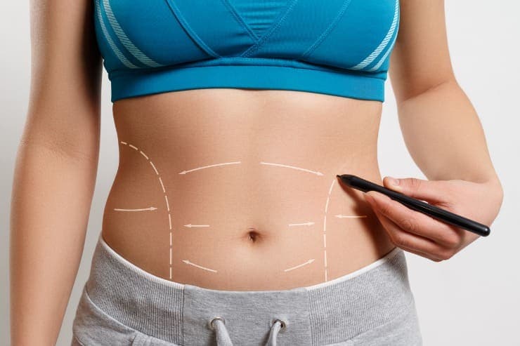 cicatrização de marcas pós-abdominoplastia