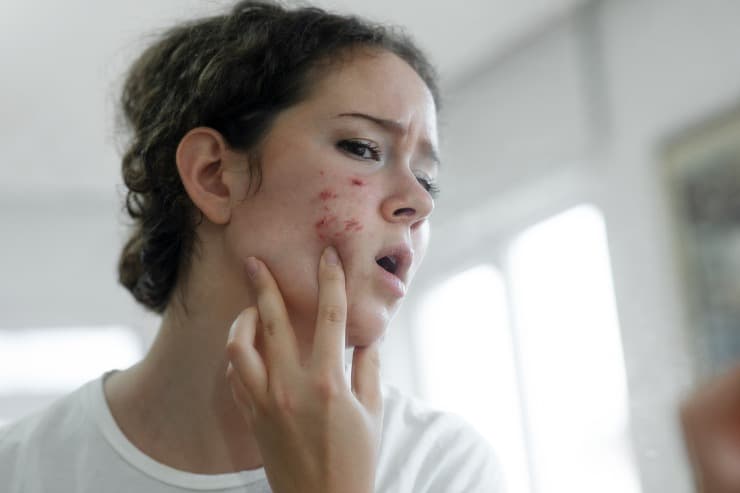 conheça as quatro fases da acne e seus respectivos tratamentos