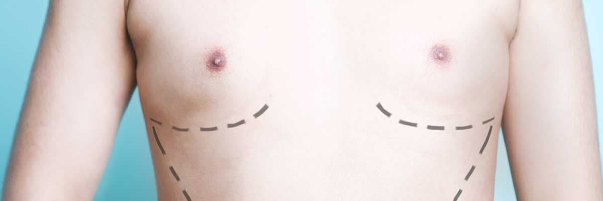 Tórax de homem com as marcações abaixo das mamas para uma ginecomastia