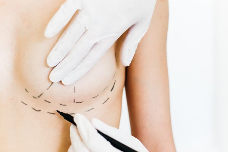 conheça os diferentes tipos de colocação de implante mamário
