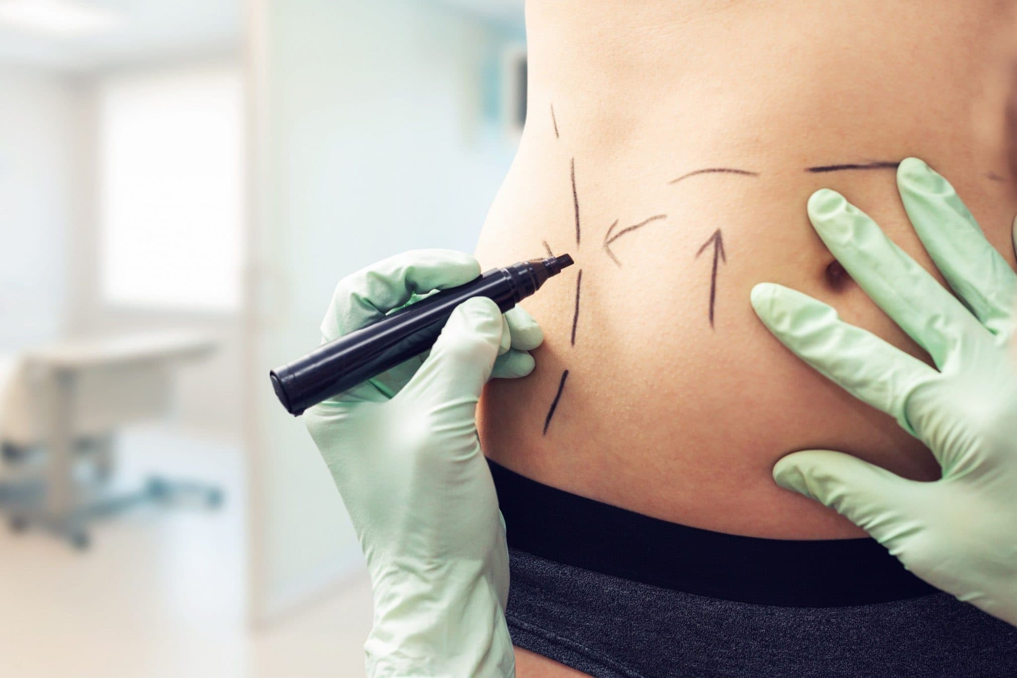 tipos de cirurgia plastica na barriga