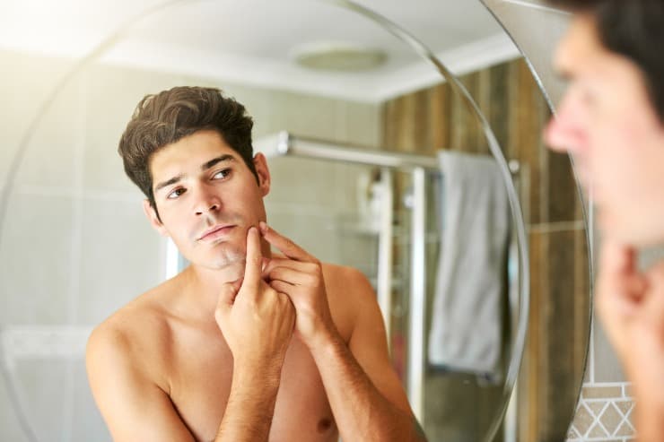 conheça algumas opções de procedimentos estéticos apra amenizar as marcas de acne.