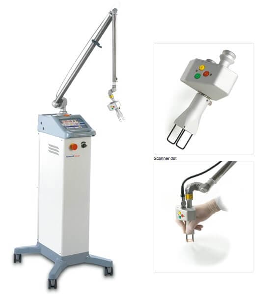 tratamento para estrias laser CO2